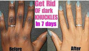 Dark knuckles cream, Potent Cream , Dark Spots remover, Real results