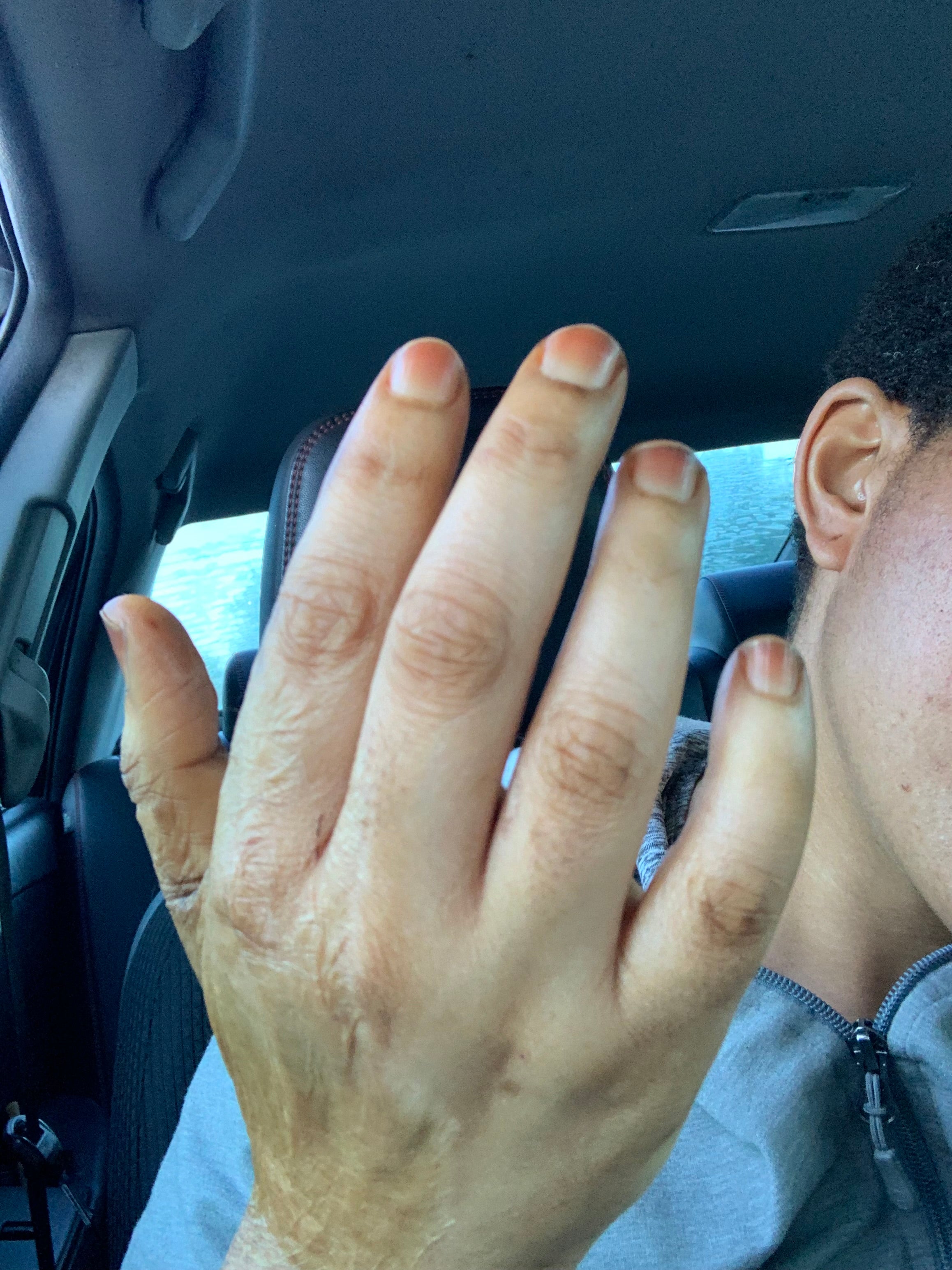 Zero Spot knuckles Remover dark knuckles elbow feet remover 5 Days actions