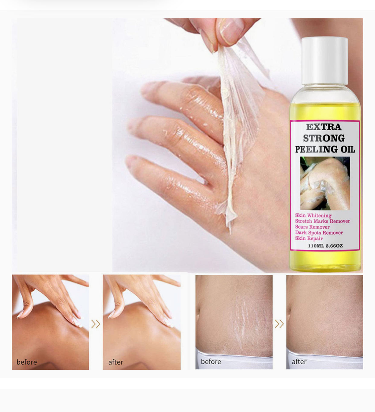 Extra Strong Peeling Oil for Deep Exfoliation, Dark Spot Clearing & Stretch Mark Repair – 110ml