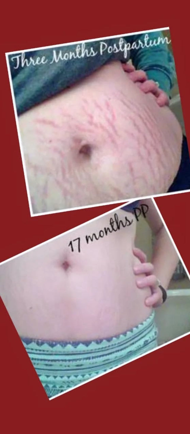 OMEGA-A STRETCH MARKS AND SCAR CREAM