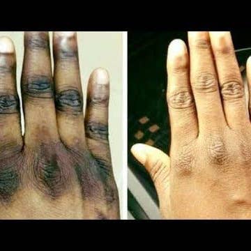 Dark knuckles cream, Potent Cream , Dark Spots remover, Real results RoyalGlow Organics