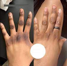 Glutathione Strong Whitening Potent Cream, Dark Spots remover, Real results x1 Glutathione Drip