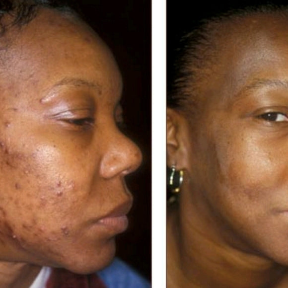 Clear-N-Smooth Anti-Blemish Cream Clear-N-Smooth