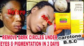 REMOVED DARK EYES CIRCLES IN 3 DAYS WITH CAROTONE & SUNSCREEN CREAM