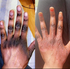 Herbal Skin Doctor Acne No more Ampoules 3ml.  (10pcs)