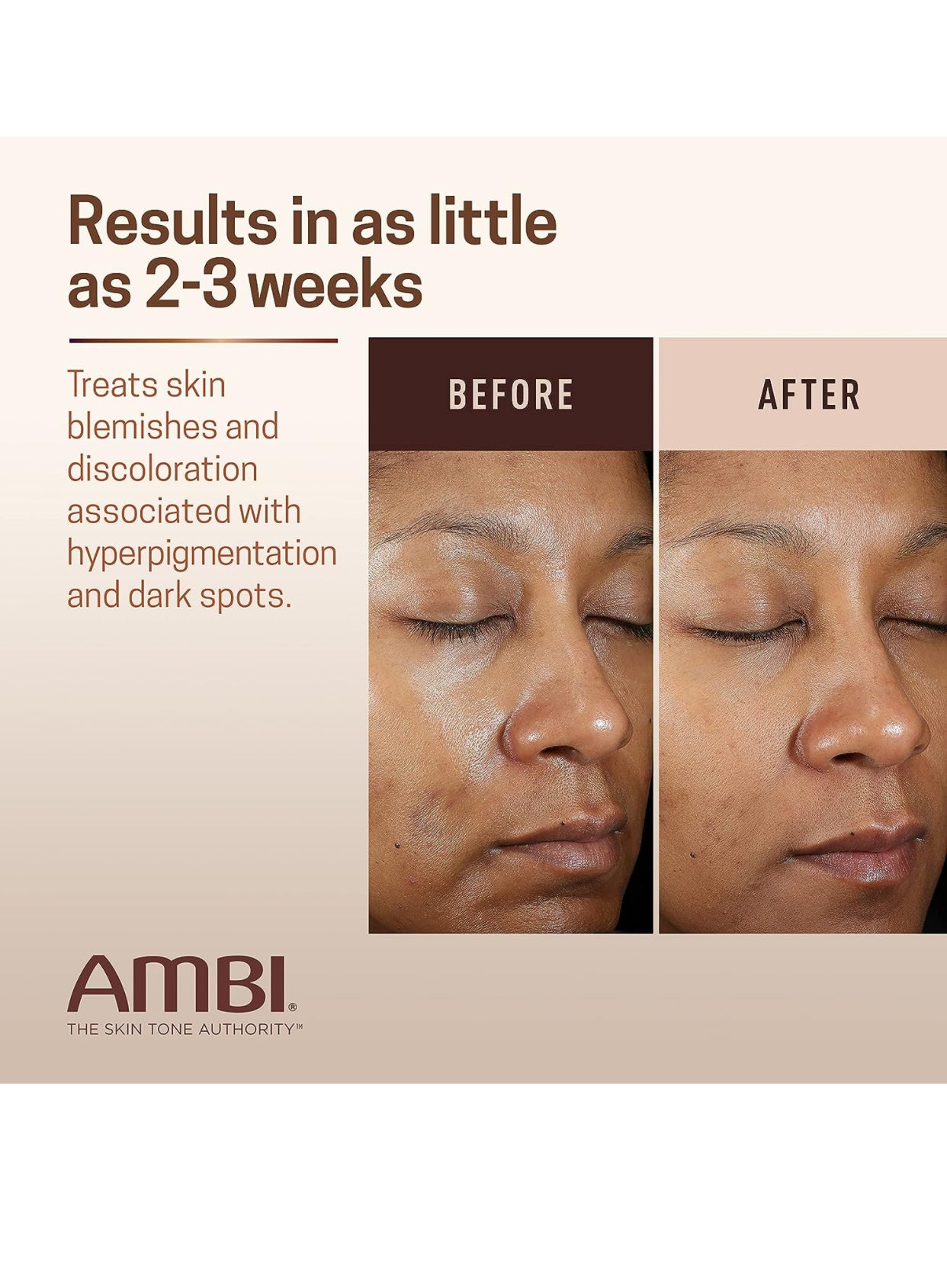 Ambi Even &amp; Clear Fade Cream, Hyperpigmentation Treatment, Dark Spot Corrector.