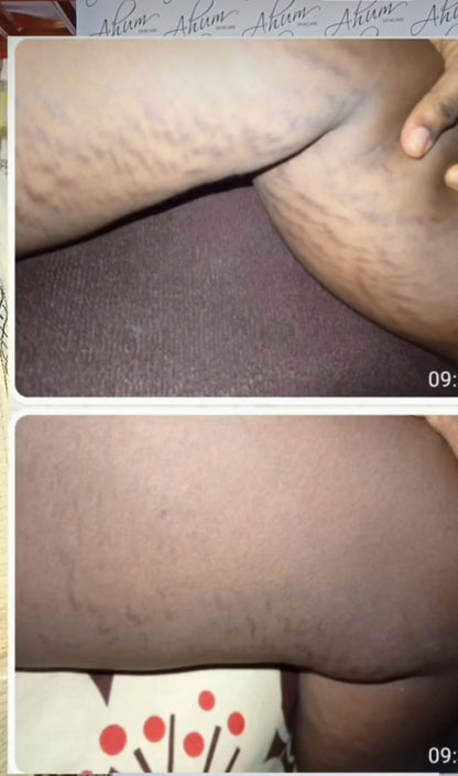 OMEGA-A STRETCH MARKS AND SCAR CREAM