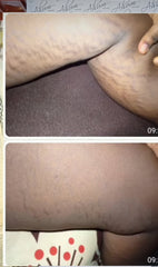 OMEGA-A STRETCH MARKS AND SCAR CREAM