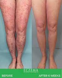 Skigud Cream 30g Fast Relief from Ringworm, Ezcema, Foot itching, &amp; Skin Infection RoyalGlow Organics