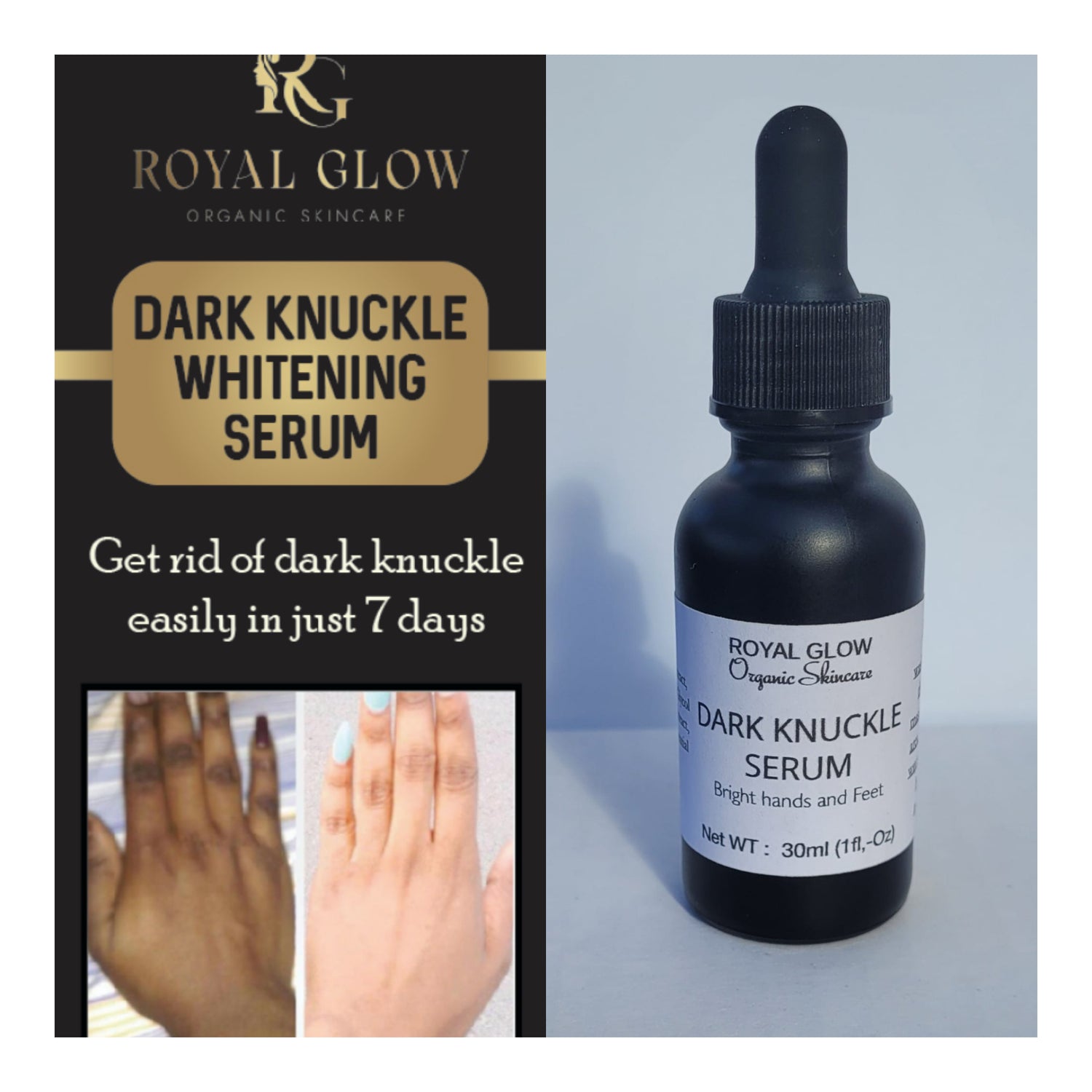 Dark knuckles cream, Potent  Cream , Dark Spots remover, Real results RoyalGlow Organics