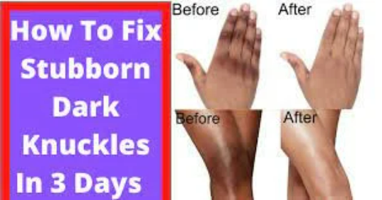 INSTANT KOJIC CLEAR WHITENING AND ANTI SPOT &amp; KNUCLE CLEAR RESULT IN 7DAYS KOJIC CLEAR