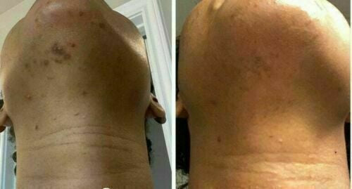 SKIN FREE FACIA WHITENING SPOT REMOVING CREAM Skin free