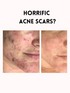 S.O.S. ZERO ACNE ANTISEPTIC CREAM FACIAL DARK SPOT AND ACNE SCARS RoyalGlow Organics